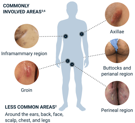 Commonly involved hidradenitis suppurativa (HS) areas