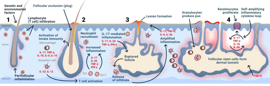 Genetic and environmental factors trigger perifollicular inflammation and lymphocyte infiltration.