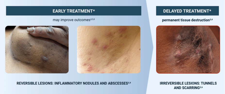 Reversible lesions: inflammatory nodules and abscesses. Irreversible lesions: tunnels and scarring.