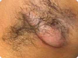 Image of hidradenitis suppurativa abscesses lesions