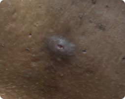 Image showing mild HS referred as Hurley Stage 1