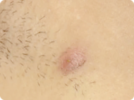 Image of hidradenitis suppurativa nodules lesions