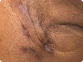Image of cord/scar of HS patient