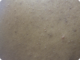 Image of folliculitis