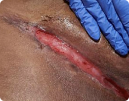 Image of cutaneous Crohn’s disease