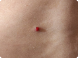 Image of pyogenic granuloma