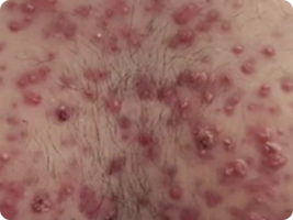 Image of acne vulgaris
