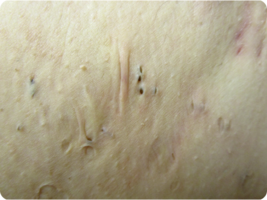 Image of comedones of HS patient