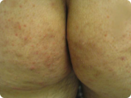 Image of hidradenitis suppurativa follicular papule/pustule lesions