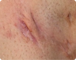 Image of sinus tract/fistula