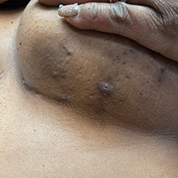 Mild hidradenitis suppurativa (HS) referred as Hurley Stage 1 