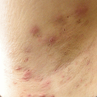 Moderate hidradenitis suppurativa (HS) referred as Hurley Stage 2 